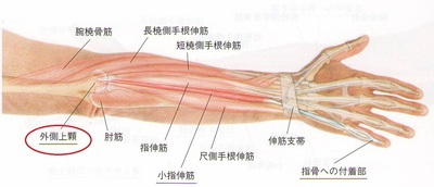 テニス肘