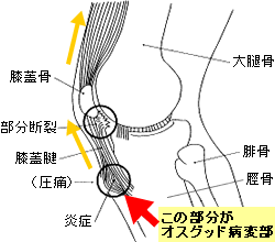 オスグッド病